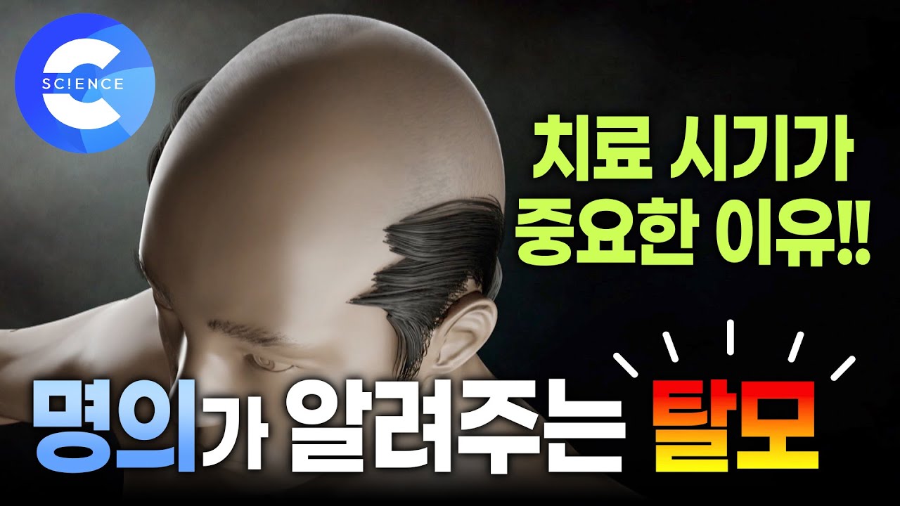 탈모 천만 명 시대!! 치료시기를 놓치면 안되는 이유 | 명의가 알려주는 탈모
